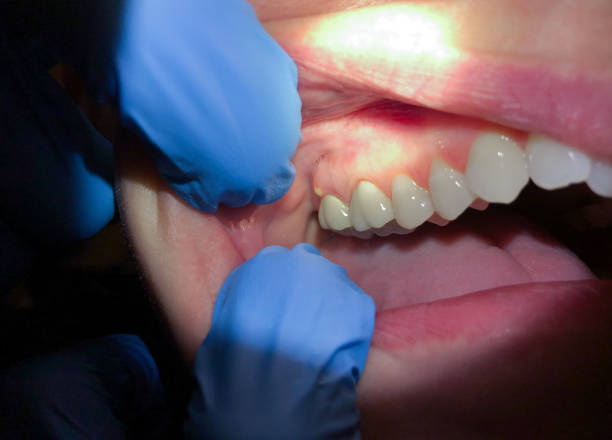 Best Urgent Care for Lost Fillings or Crowns in Sa De Oro Mount Helix, CA